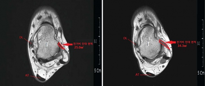 <좌: 정상인 발목 단면MRI , 우: 만성발목불안정증 환자 발목 단면 MRI >