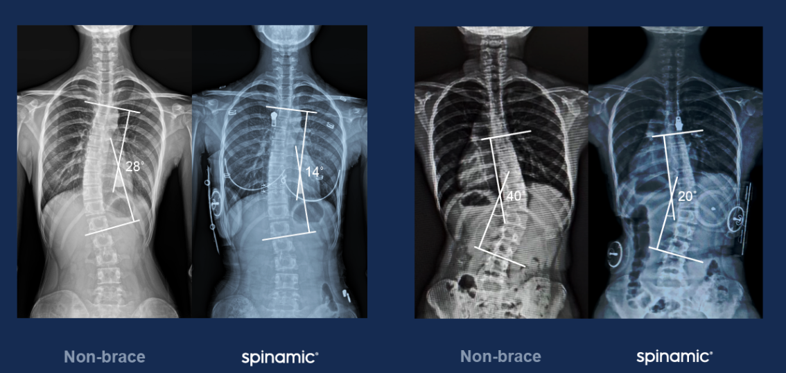 스파이나믹 착용 전후 환자 X-ray 비교