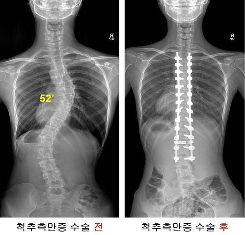 서울아산병원 척추측만증센터는 지난 2015년 개소 6년만에 척추층만증수술 1천례를 달성했다.